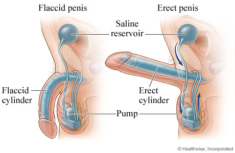 Treatment for Erectile Dysfunction